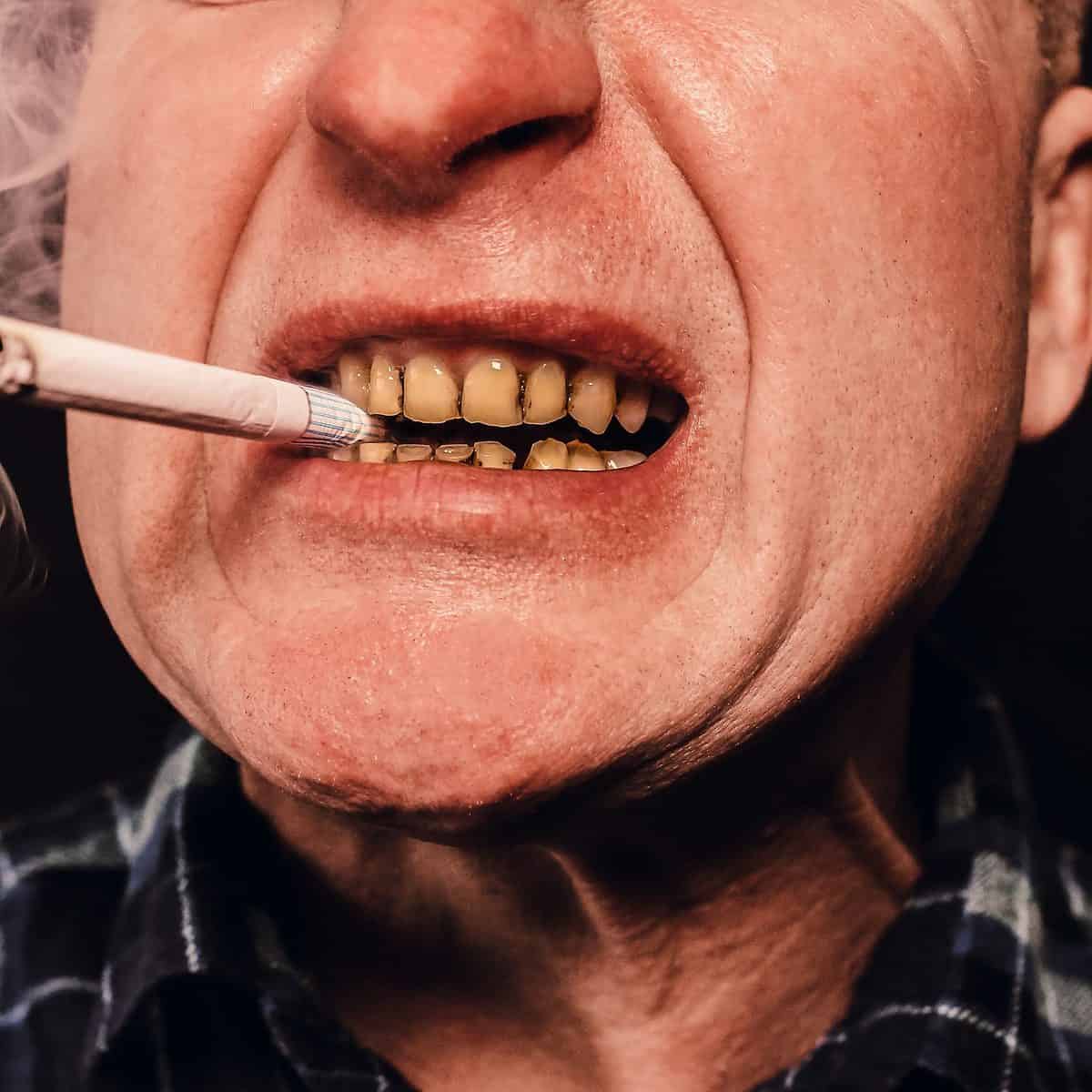 When can I smoke after a tooth extraction